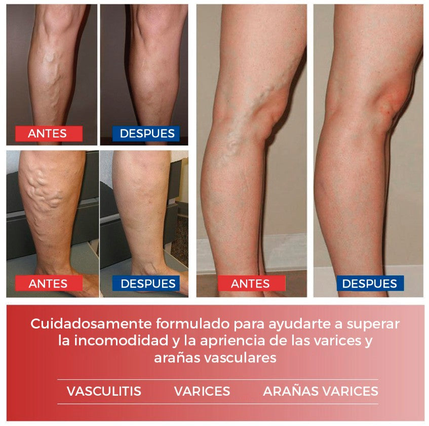 PARCHES PARA VENAS VARICES